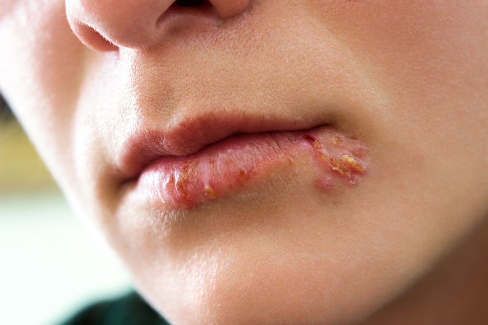 Squaric acid dibutyl ester (SADBE) - A New Treatment For Herpes Labialis (Cold Sores)?