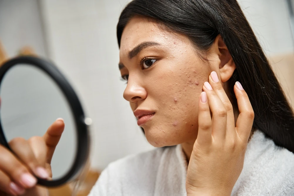 3 of the Top Ways to Treat Acne