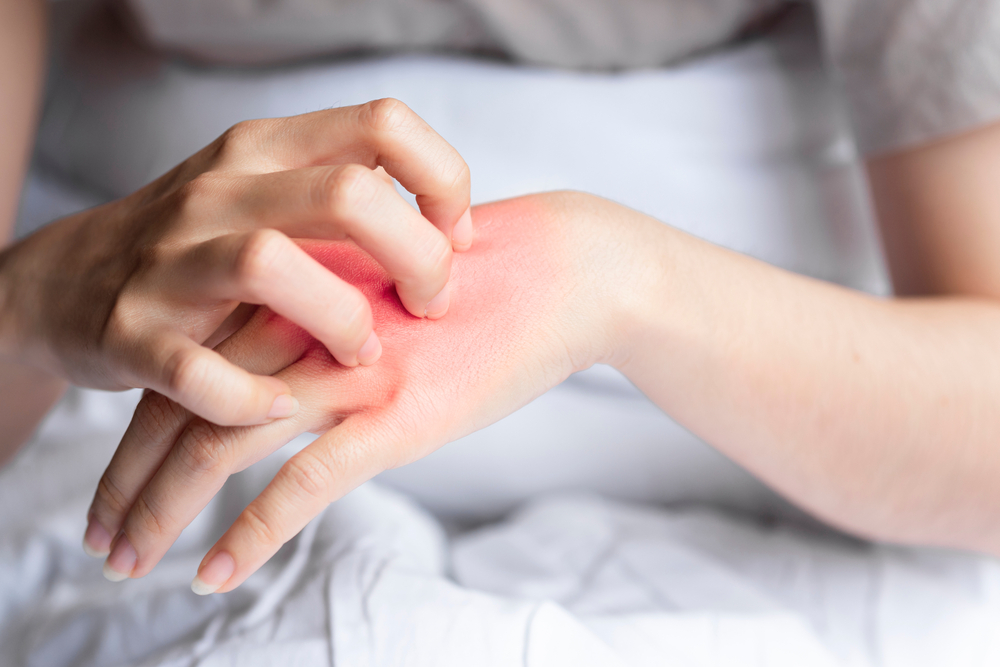 4 Common Types of Rashes and How to Treat Them