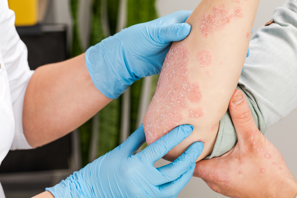 What Is Psoriasis?